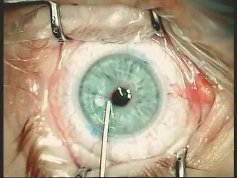 Patientenbericht Augenlaserbehandlung (Femto-LASIK)