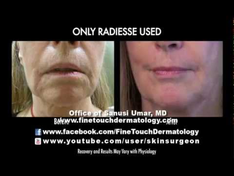 solution jowls for Treating Patient Surgically Jowls Before After Non and solution jowls for Treating Patient Surgically Jowls Before After Non and