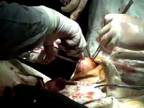 Gout (Uric Acid) Tophy Removal / Surgery - YouTube