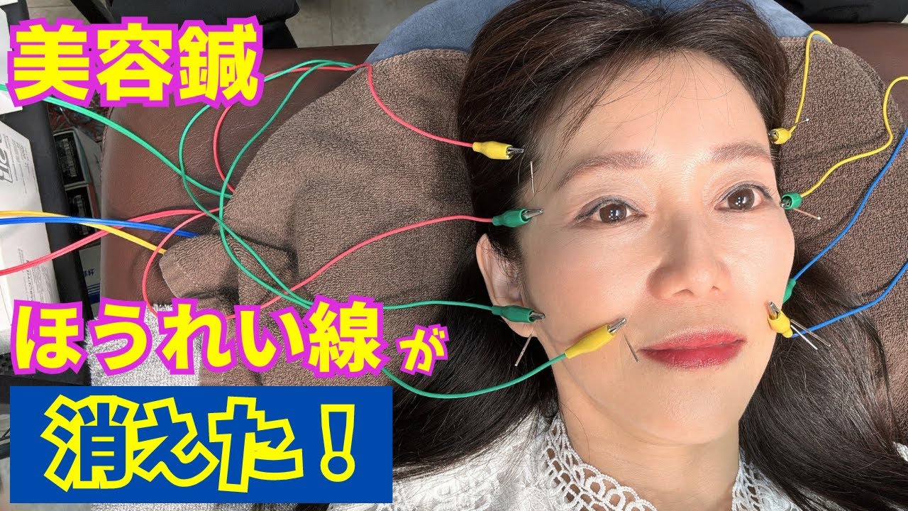 美容鍼でリフトアップ!!長年のほうれい線が消えた!