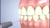 Video for Dental Pik