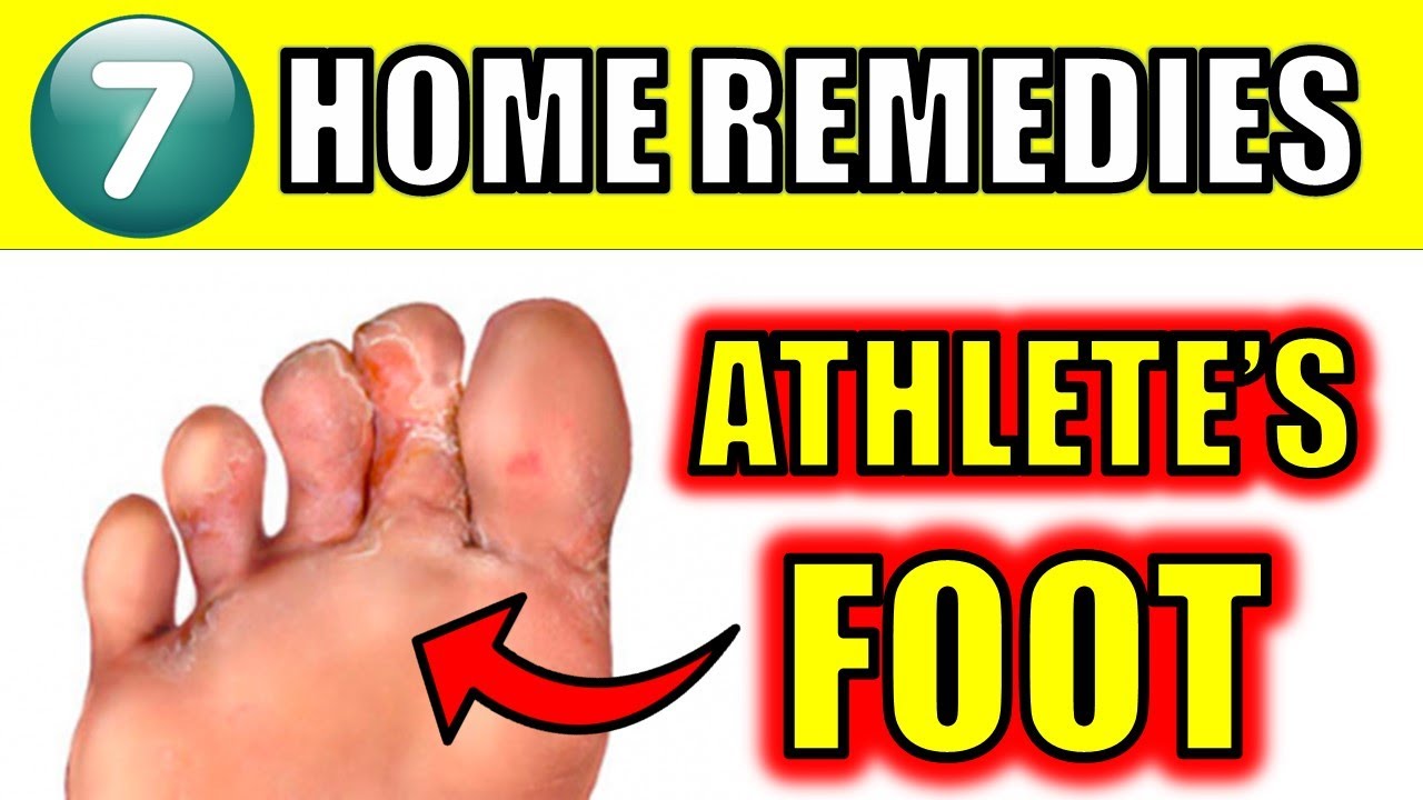 Athlete’s Foot : 7 Amazing Home Remedies To Beat This Fungal Infection￼