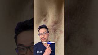 This Is Not Acne