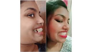 Braces Before/After Journey braces ortho trending trendingvideo ytshorts shorts shortvideo