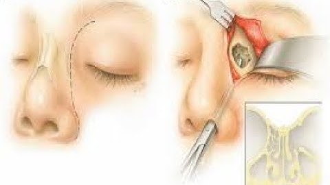 Ethmoidectomy CPT code - simplify medical coding