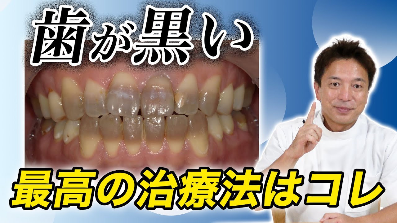 Tetracycline Dental Specialist Explains] Laminate Veneers