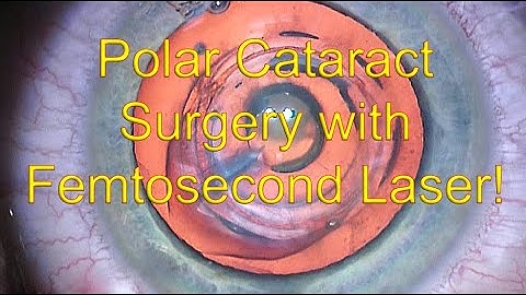 Polar cataract surgery - Femtodelineation technique - Dr Simon Chen