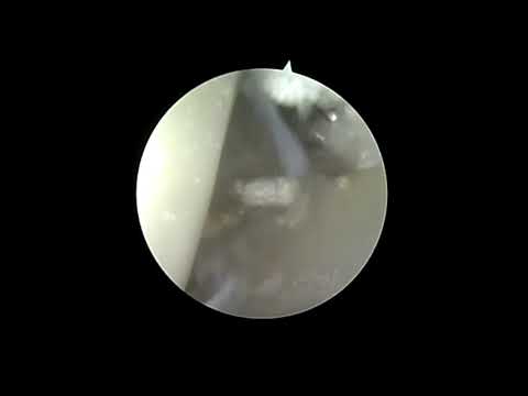 Arthroscopic Gout Removal