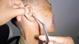Something Stuck In Elderly Man&#39;s Ear Finally Removed After 2 Years | Guess What