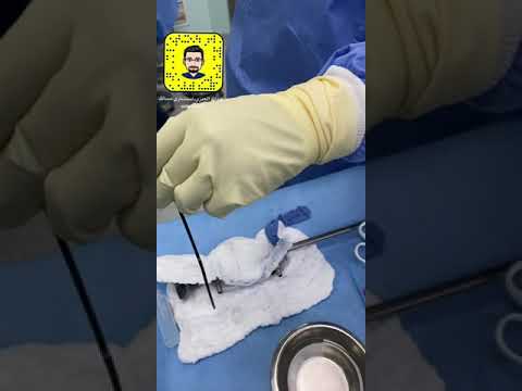 المنظار المرن للكليه