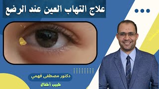 التهاب العين عند الرضع بعد الولاده | افرازات عين الرضيع