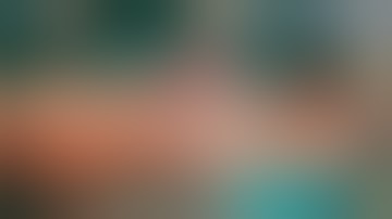 Ilizarov in infected tibia nail fracture non union - Dr Shamsul Hoda Ilizarov Cases