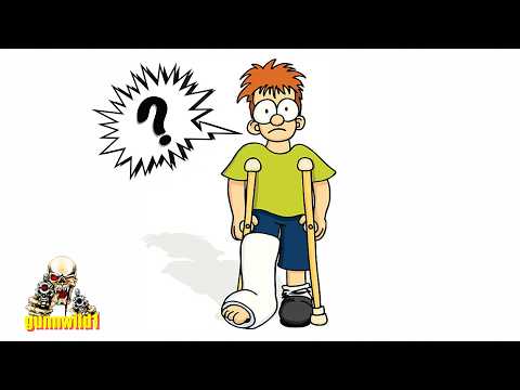 Broken leg update 2