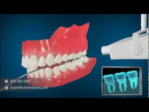 Medical Animation explaining Dental Radiography | Dental X-Rays