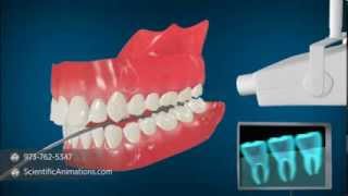 Medical Animation Explaining Dental Radiography | Dental X-Rays