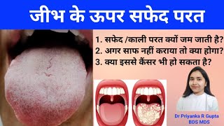 जीभ पर सफेद परत क्यों बन जाती है? क्या यह कैंसर कर सकती है? White coating on Tounge