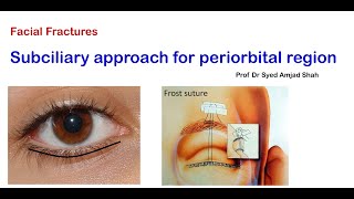 Subciliary approach for Periorbital region | English | Oral Maxillofacial Surgery | Syed Amjad Shah