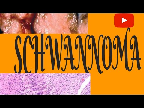 Schwannoma-clinical features,pathogenesis,management.Schwannoma(Neurilemmoma)-usmle,neetpg,plab,fmge