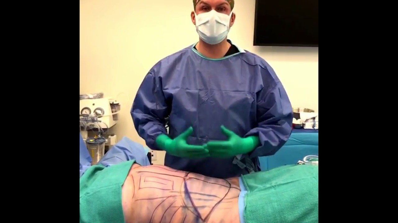 ⁣Visage Clinic's Dr. Marc DuPéré Live Surgery: Tummy Tuck (Abdominoplasty) with Liposuction