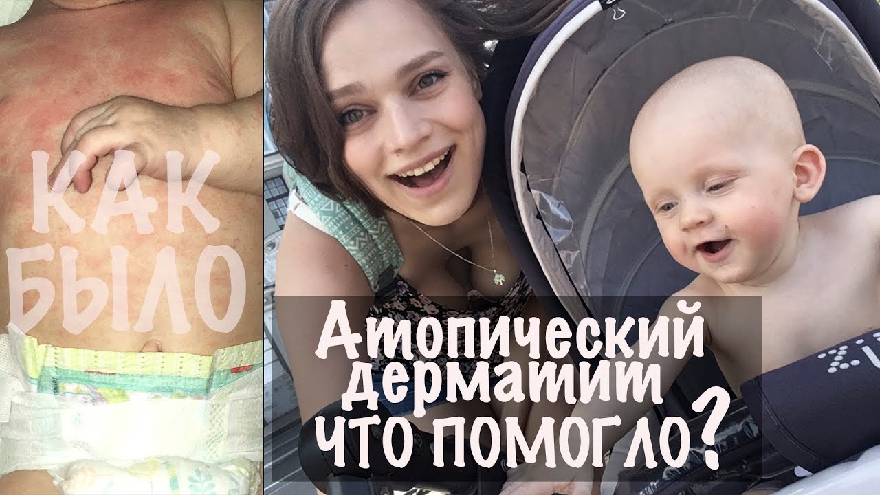 ЛЕЧЕНИЕ АТОПИЧЕСКОГО ДЕРМАТИТА - Semenova