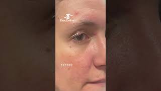 Large Right Upper Eyelid Chalazion Surgery 👁️✨