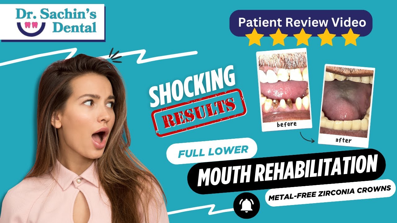 Lower Full Mouth Restoration with Metal-Free Zirconia Crowns 