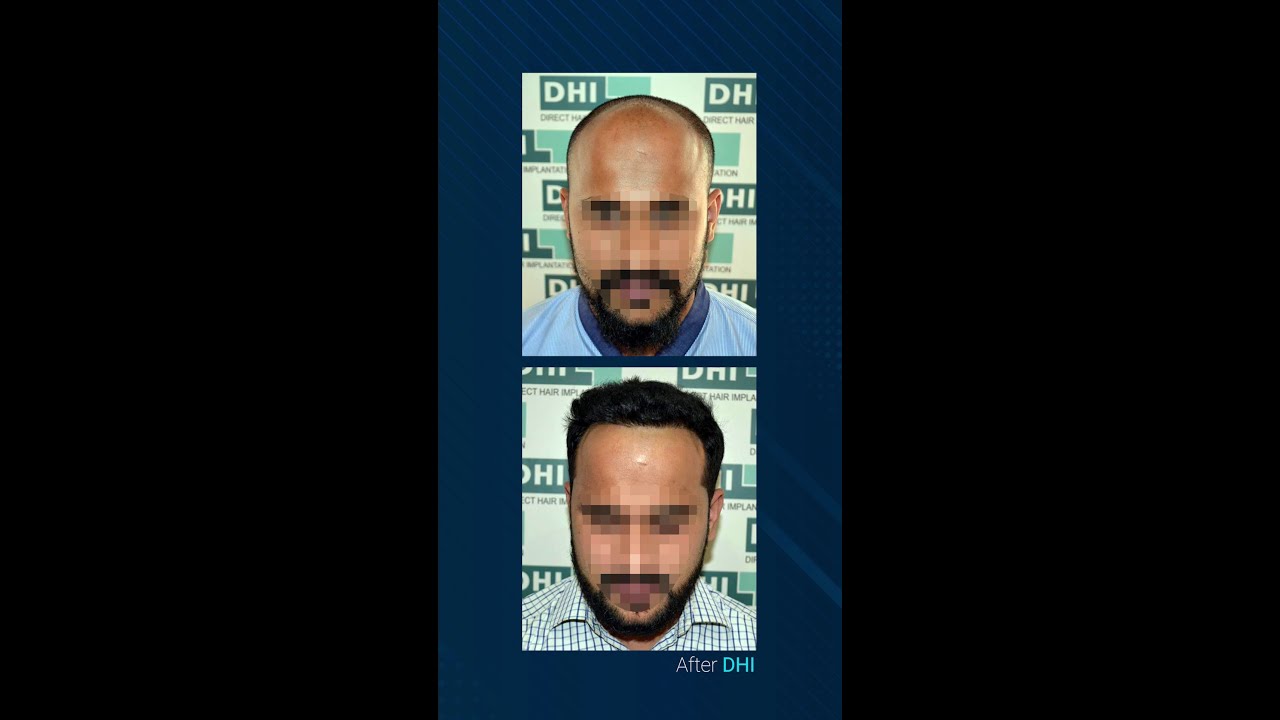 Changing looks, transforming lives 😎 | DHI Hair Transplant Results