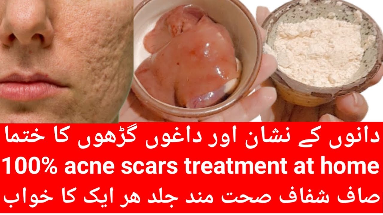 Easy Home Remedy for Acne & Scars Gharelu llaj Acne treatment at Home