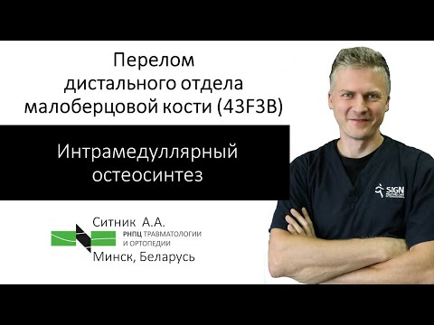 Интрамедуллярный остеосинтез малоберцовой кости