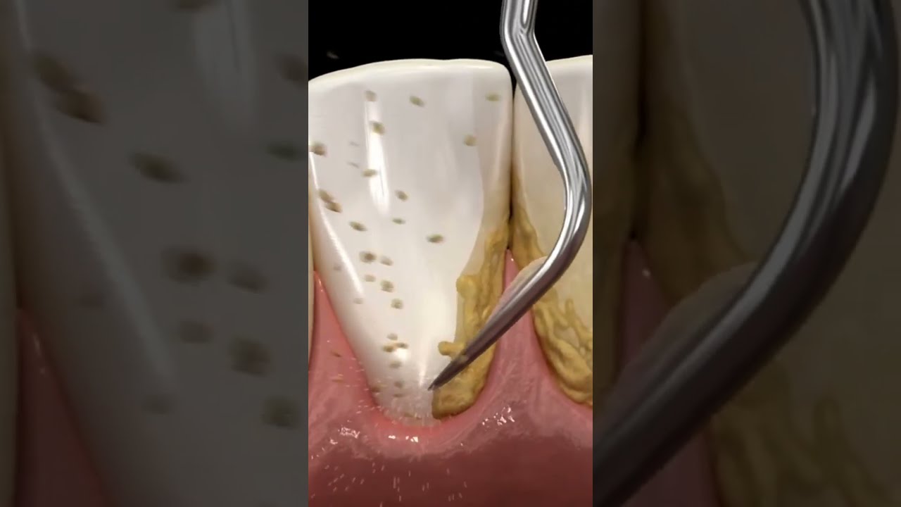 Cleaning Teeth With Ultrasonic Scaler Shorts Dentist Teethcleaning