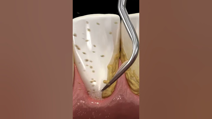 cleaning teeth with ultrasonic scaler #shorts #dentist #teethcleaning