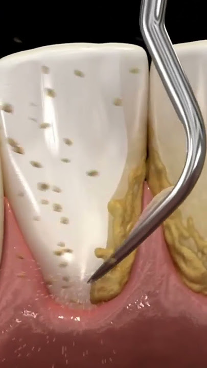 cleaning teeth with ultrasonic scaler #shorts #dentist #teethcleaning