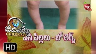 Jeevanarekha child care | Bow Legs | 9th November 2016 | జీవనరేఖ చైల్డ్