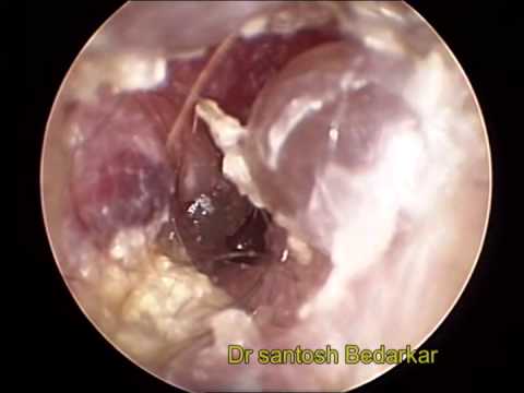 HERPES ZOSTER OTICUS - YouTube