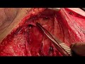 Field of View after Axillary Dissection in Modified Radical Mastectomy for Breast Cancer. Anatomy