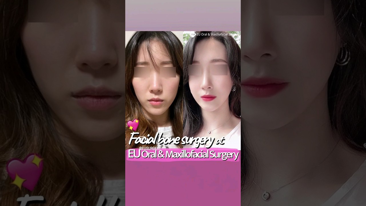 Korean Double Jaw Surgery + V-Line Surgery + Zygoma Reduction Surgery Results | (Before & After)