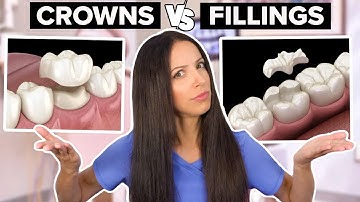Dental Crowns Vs Dental Fillings (What