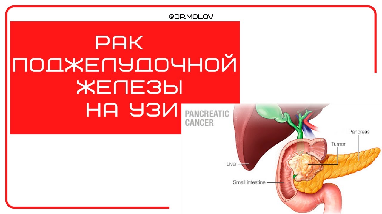 Рак поджелудочной железы на УЗИ - YouTube