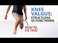 Why You Need to Fix Dynamic Knee Valgus NOW
