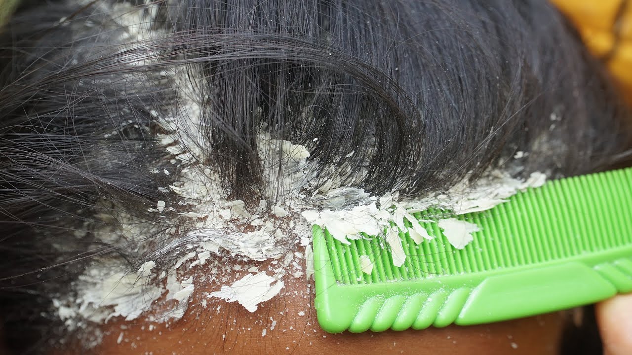 Scratching My Scalp for 24 Hours: Dandruff Test + What Works #202 - YouTube