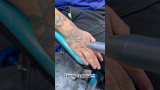 Removing With Picosecond Laser