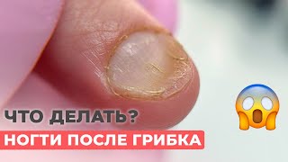 Грибок ногтей | Можно ли делать покрытие гель лаком?