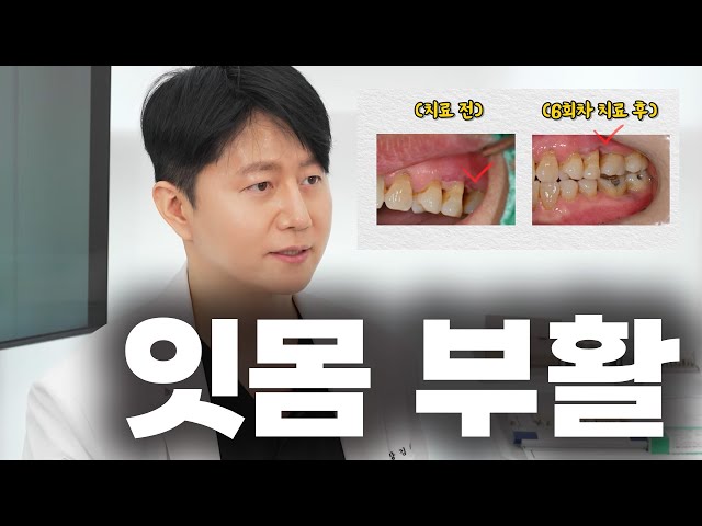 치아 함부로 뽑지 마세요 제발 (엠도게인)