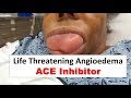 Life threatening ace inhibitor induced angioedema