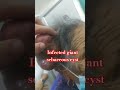 sebaceous cyst #surgery #neurosurgery #radiology #medstudent #anatomy #neurology #shorts