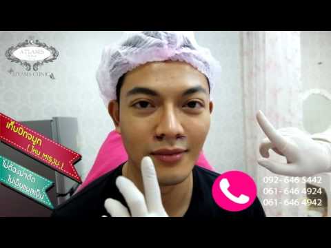 Atlases Clinic By หมอปู : เก็บปีกจมูกไม่ต้องผ่าตัด ไม่มีรอยแผล ไหม MISJU (คุณแม็ค)