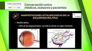 ¿Puede la EM afectar al movimiento de los ojos?