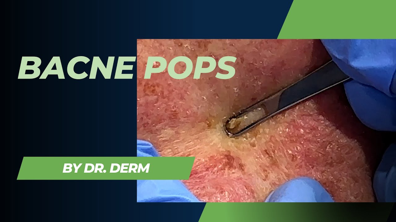 2023 Acne pops video