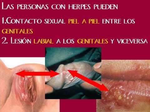 Herpes Genital