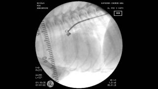 PDA COIL CLOSURE IN A 2,5kg MALTESE DOG